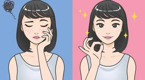 Acne, come prevenirlo? Prevenzione e prodotti naturali