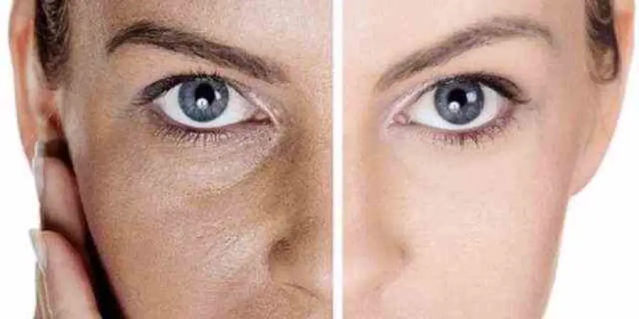 Pori dilatati, punti neri e Acne: 5 rimedi naturali per una pelle perfetta