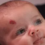 Emangiomi Infantili: Cosa sono e quali sono i centri italiani all'avanguardia