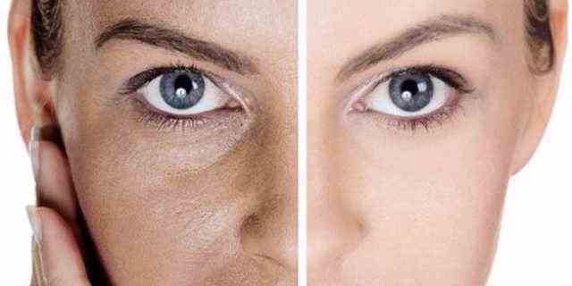 Pori dilatati, punti neri e acne: 5 rimedi naturali per una pelle perfetta